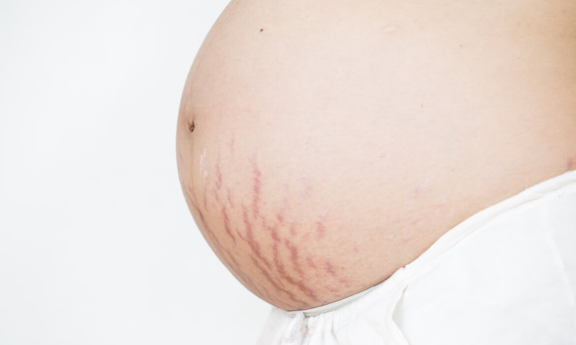 Cómo evitar las estrías en el embarazo