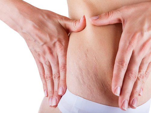 Piel de mujer con estriás Piel de mujer con estriás