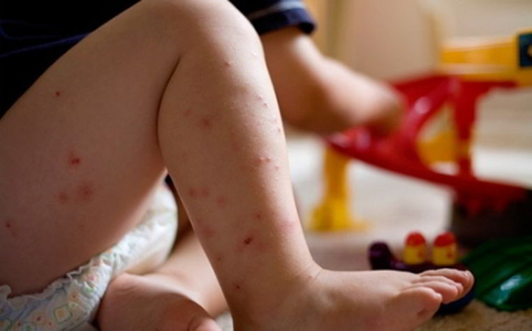 picadura de insectos en los ninos bebe con muchas picaduras
