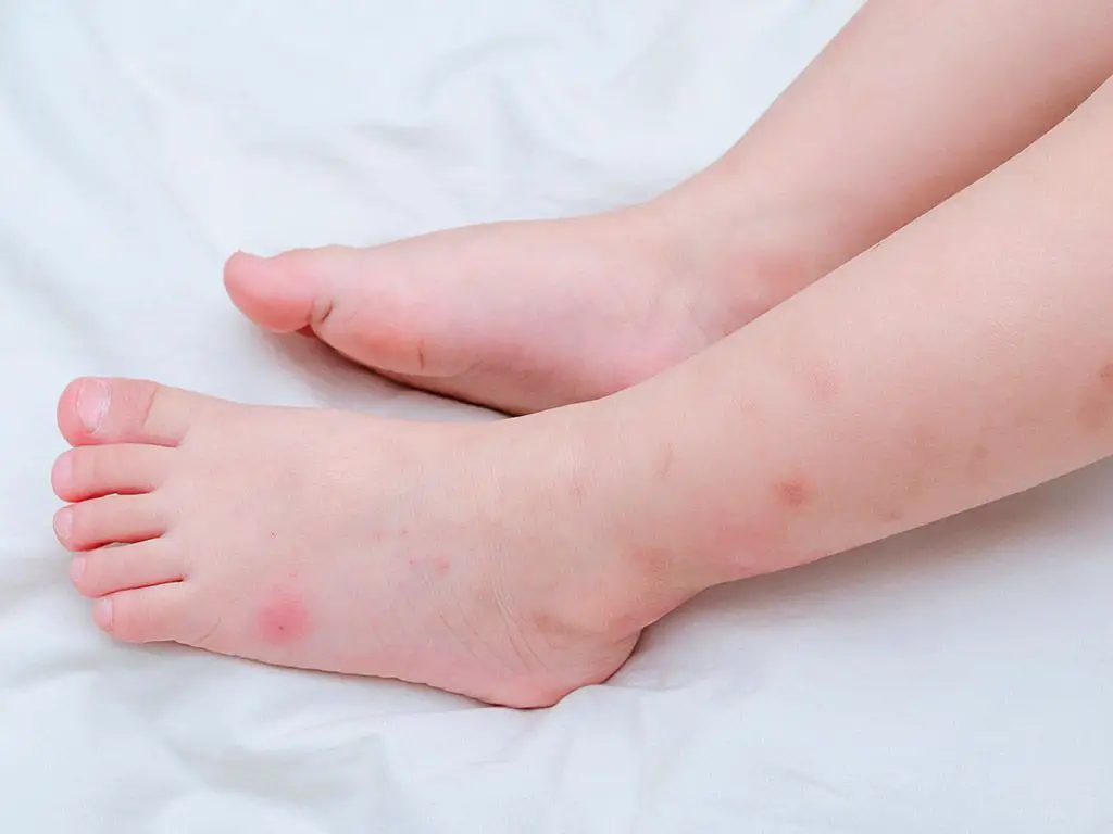 picadura de insectos en niños bebe con picaduras