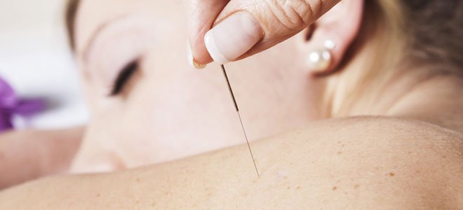 acupuntura para adelgazar funciona