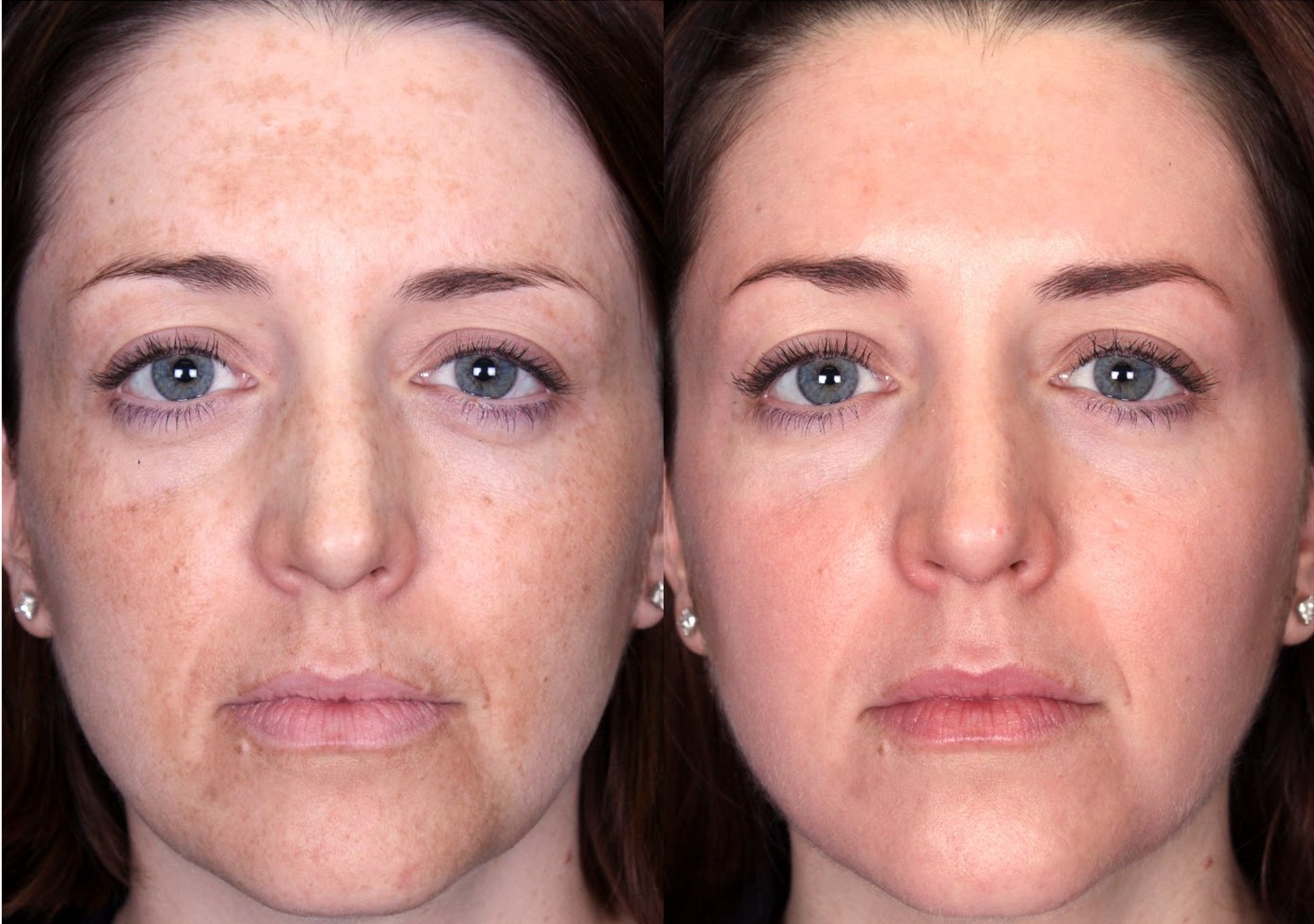 peeling facial manchas