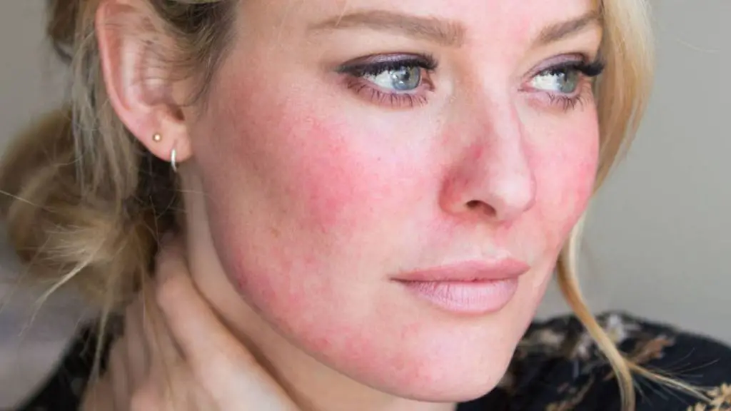 piel rosacea