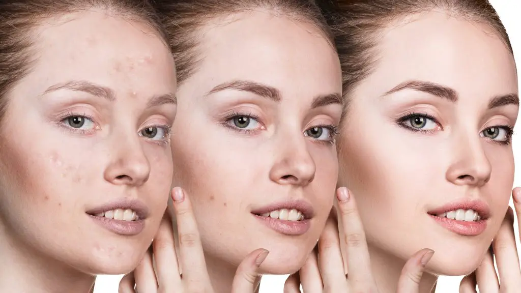 Las chicas que tienen acné pueden lucir una piel bonita usando los productos adecuados
