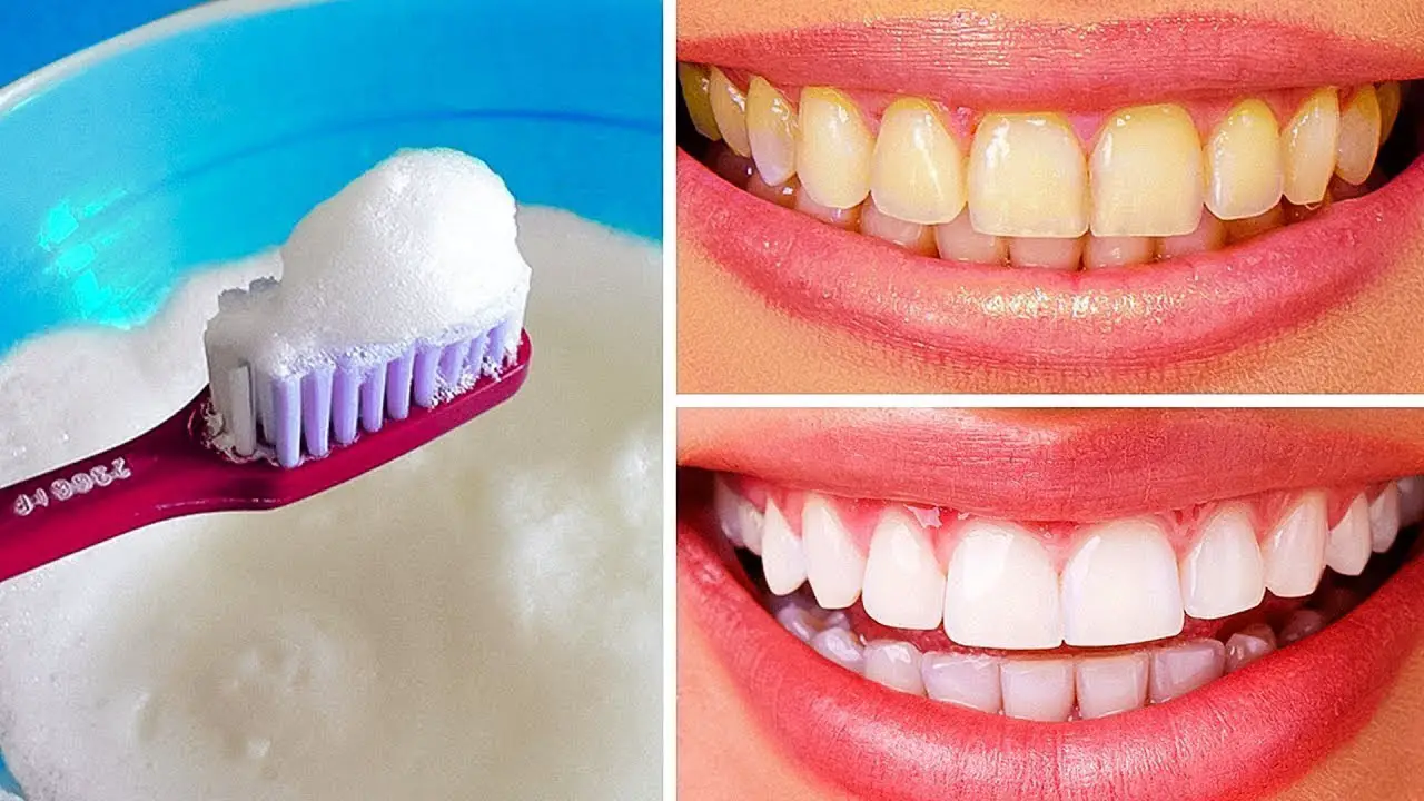 blanqueamiento dental 5