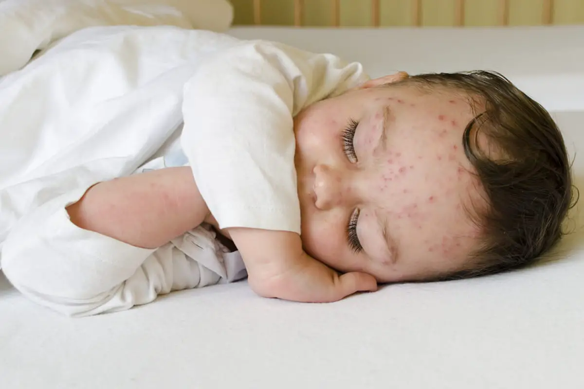 Como Calmar La Picazon De La Varicela En Niños