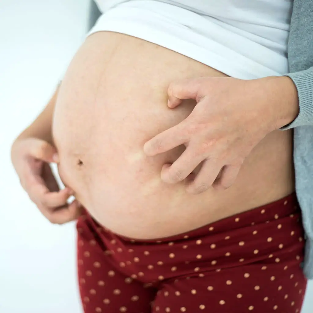 varicela en el embarazo sintomas
