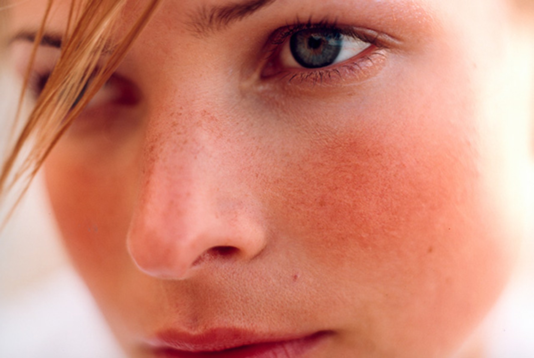 mejor crema para rosacea recomendaciones