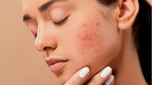 remedios para el acne