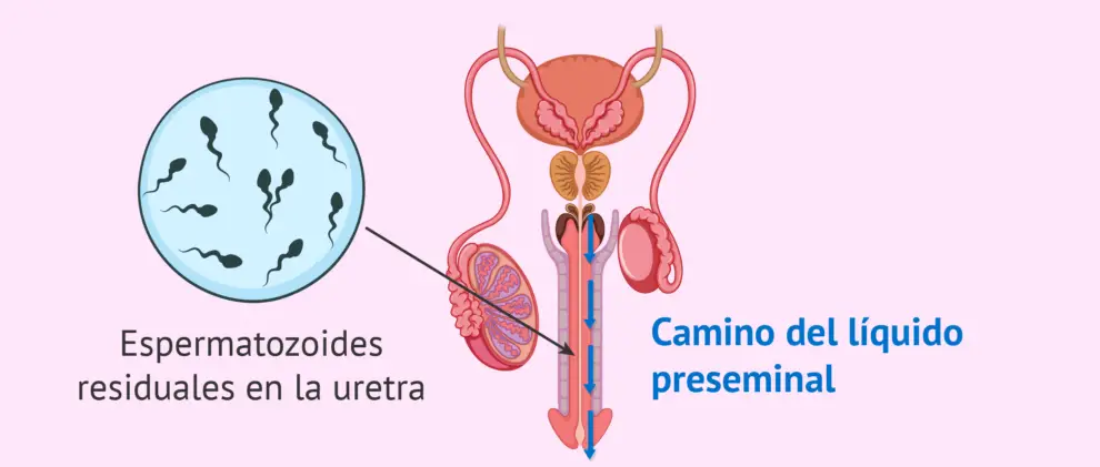 ¿Qué probabilidad hay de quedar embarazada con el líquido preseminal?