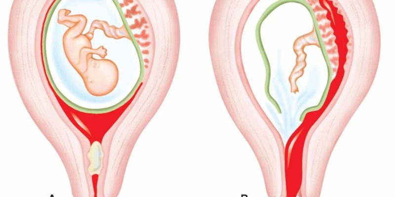aborto espontáneo tratamiento